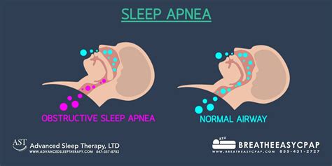 Understanding Apnea: Definition and Types